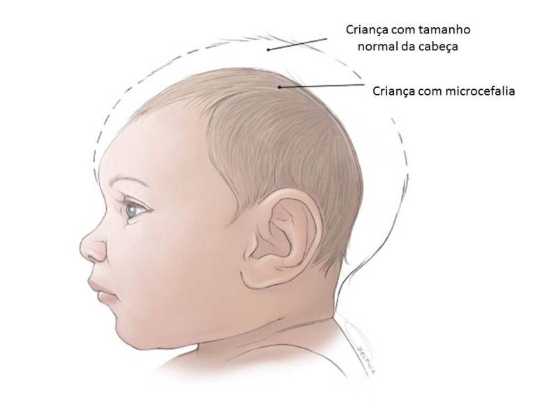RN contabiliza 181 casos suspeitos de microcefalia