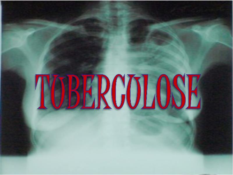 Programa de Controle da Tuberculose apresenta protocolo de fluxo de material para diagnóstico da doença