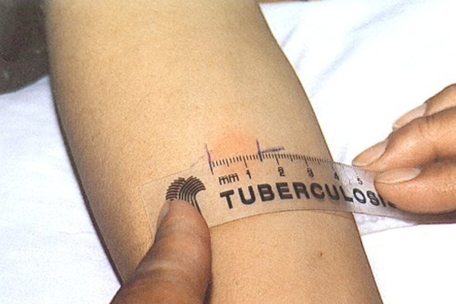 Natal possui cinco unidades de referência para testes de diagnóstico de tuberculose 